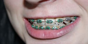 Colocação de Aparelho para corrigir os dentes na Clínica BH Sorriso em BH